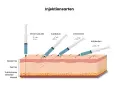 Illustration zeigt verschiedene Injektionsarten: intramuskulär (90°), subkutan (45°), intravenös (25°) und intrakutan (15°), um zu zeigen, wie man weiter spritzen kann.