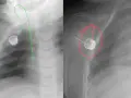Röntgenbilder zeigen einen Port links oder rechts, der für die Medikamentengabe implantiert wurde.