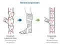 Venenkompression: Von erweiterter Vene mit gestörter Durchblutung zur eingeengten Vene mit verbesserter Blutströmung. Eine Alternative zur Thrombosespritze.