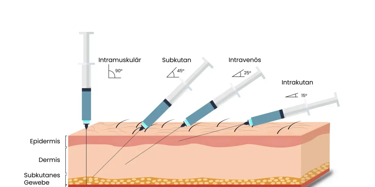 Illustration zeigt verschiedene Injektionsarten: intramuskulär (90°), subkutan (45°), intravenös (25°) und intrakutan (15°), um zu zeigen, wie man weiter spritzen kann.