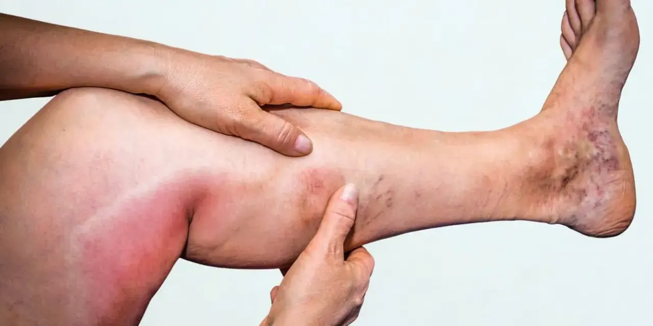 Geschwollenes, gerötetes Bein mit Krampfadern, deutet auf eine Thrombose in beiden Beinen hin.