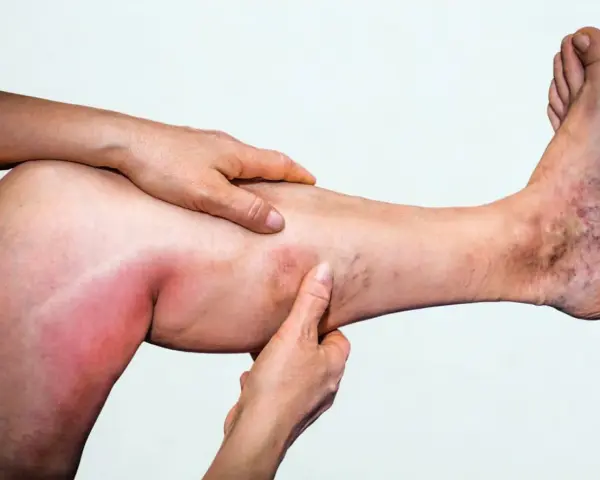 Geschwollenes, gerötetes Bein mit Krampfadern, deutet auf eine Thrombose in beiden Beinen hin.