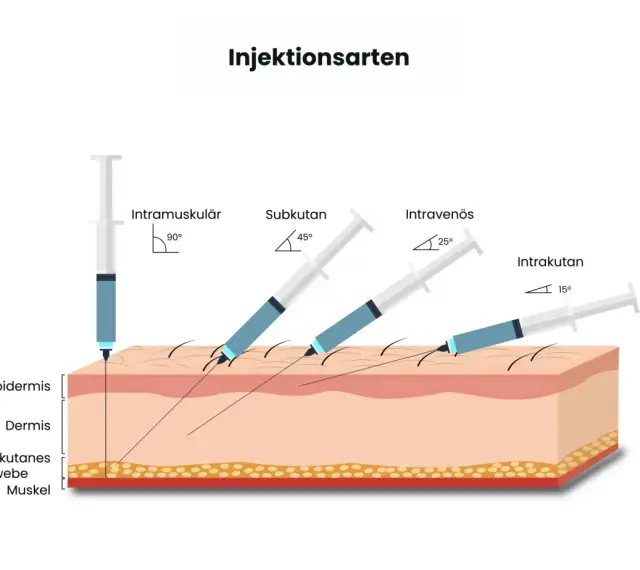 Illustration zeigt verschiedene Injektionsarten: intramuskulär (90°), subkutan (45°), intravenös (25°) und intrakutan (15°), um zu zeigen, wie man weiter spritzen kann.