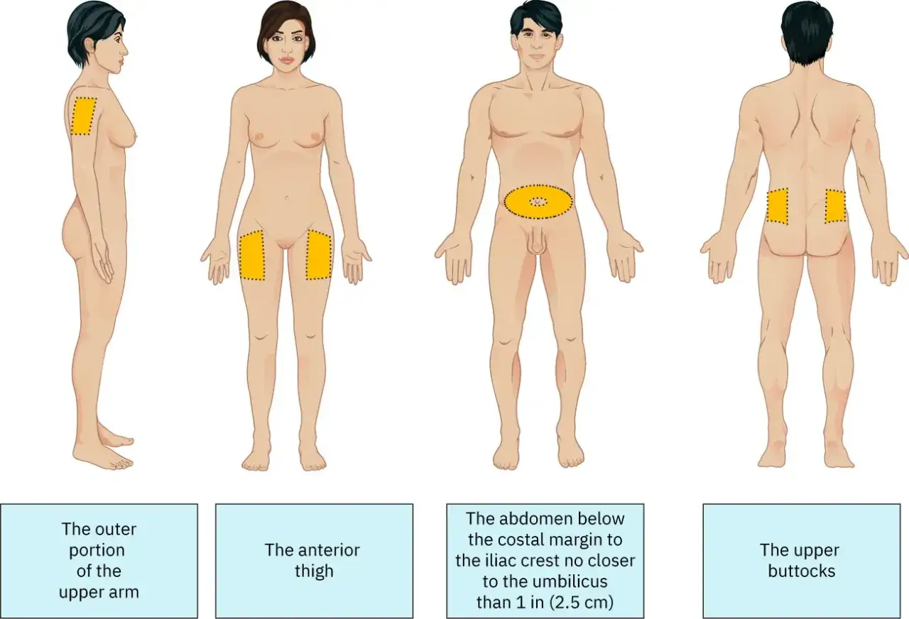 Übersicht der subkutanen Injektionsorte: Oberarmaußenseite, vordere Oberschenkel, Bauch (Abstand zum Nabel beachten) und oberes Gesäß.