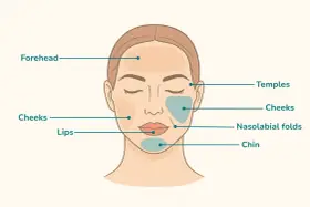 Gesichtspartien, die für Behandlungen wie Filler oder Botox in Frage kommen: Stirn, Schläfen, Wangen, Lippen, Nasolabialfalten und Kinn. Hier wird gezeigt, wohin spritzen.