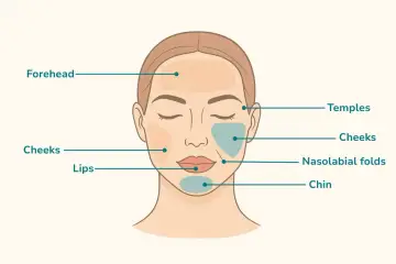 Gesichtspartien, die für Behandlungen wie Filler oder Botox in Frage kommen: Stirn, Schläfen, Wangen, Lippen, Nasolabialfalten und Kinn. Hier wird gezeigt, wohin spritzen.