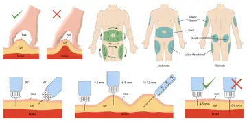 Anleitung: wie spritze ich Insulin richtig in den Oberschenkel. Zeigt Hautfalte, Injektionswinkel (90°/45°), Nadellänge und Körperstellen.