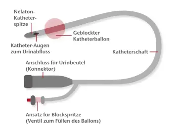 Schema eines Blasenkatheters mit Nélaton-Spitze, Ballon und Anschluss für Urinbeutel. Wer darf Katheter legen? Geschultes medizinisches Personal.