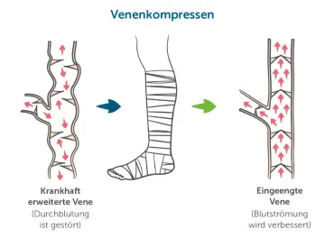 Venenkompression: Von erweiterter Vene mit gestörter Durchblutung zur eingeengten Vene mit verbesserter Blutströmung. Eine Alternative zur Thrombosespritze.