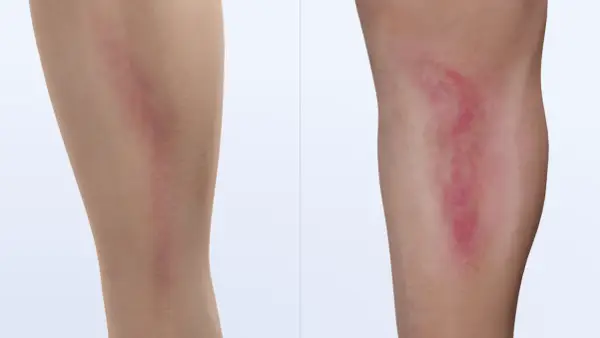 Vergleich zweier Beine: Links ein unauffälliger Bereich, rechts eine gerötete, geschwollene Stelle, die auf Thrombophlebitis Symptome hinweisen könnte.