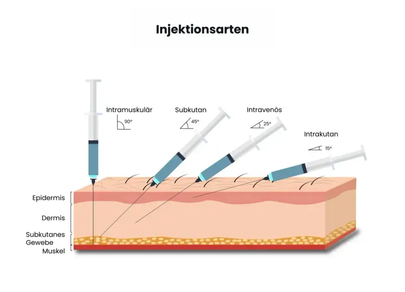 Illustration zeigt verschiedene Injektionsarten: intramuskulär (90°), subkutan (45°), intravenös (25°) und intrakutan (15°), um zu zeigen, wie man weiter spritzen kann.