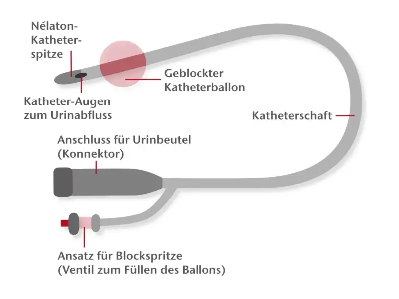Schema eines Blasenkatheters mit Nélaton-Spitze, Ballon und Anschluss für Urinbeutel. Wer darf Katheter legen? Geschultes medizinisches Personal.